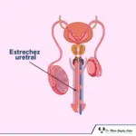 Estrechez uretral: síntomas, impacto en la calidad de vida y tratamiento