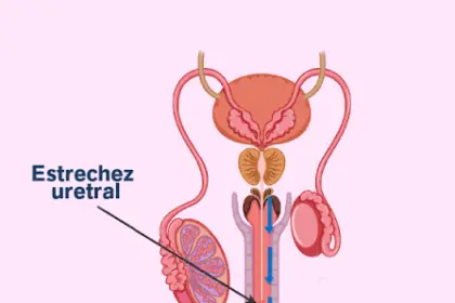 Estrechez uretral: síntomas, impacto en la calidad de vida y tratamiento