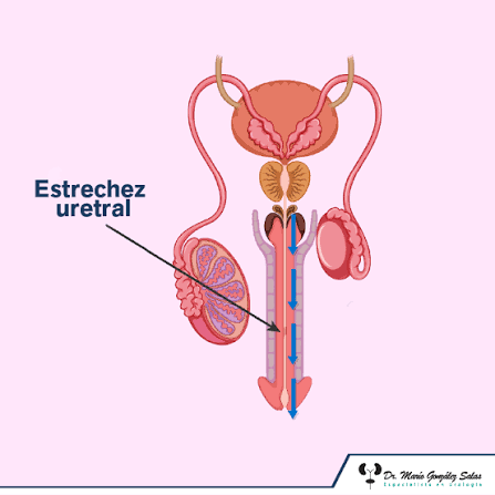 Estrechez uretral: síntomas, impacto en la calidad de vida y tratamiento 1 Estrechez uretral: síntomas, impacto en la calidad de vida y tratamiento