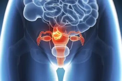 Cáncer ginecológico: señales de alerta que toda mujer debe conocer