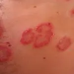 Día Mundial de la Dermatitis Atópica: causas y síntomas de la enfermedad