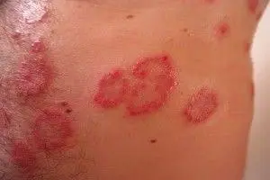 Día Mundial de la Dermatitis Atópica: causas y síntomas de la enfermedad