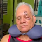 Hombre pierde ojo tras brutal agresión en La Guáyiga y exige justicia