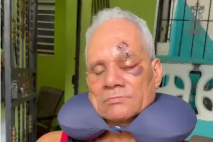 Hombre pierde ojo tras brutal agresión en La Guáyiga y exige justicia