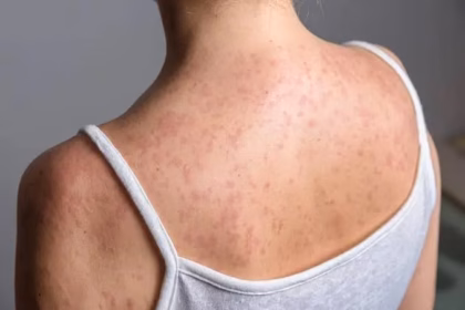 New York declares emergency due to measles outbreak in the United States